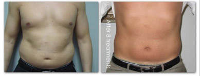 laser lipo body contouring results image male