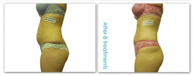 laser lipo body contouring results image