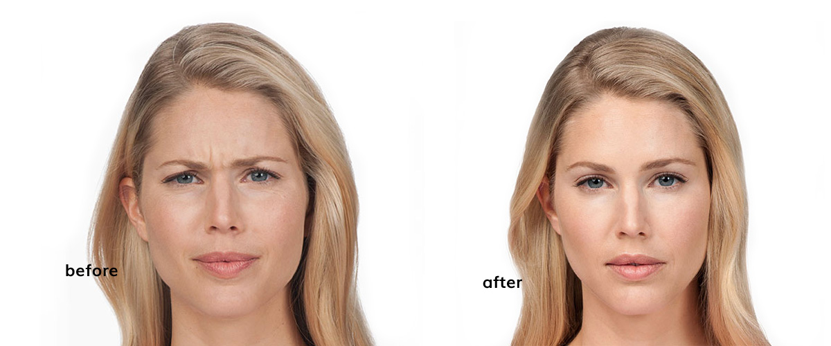 Botox - NuYou
