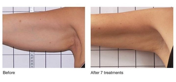 image of underarm before and after Refit body contouring