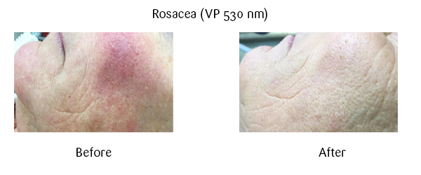 rosacea before and after image