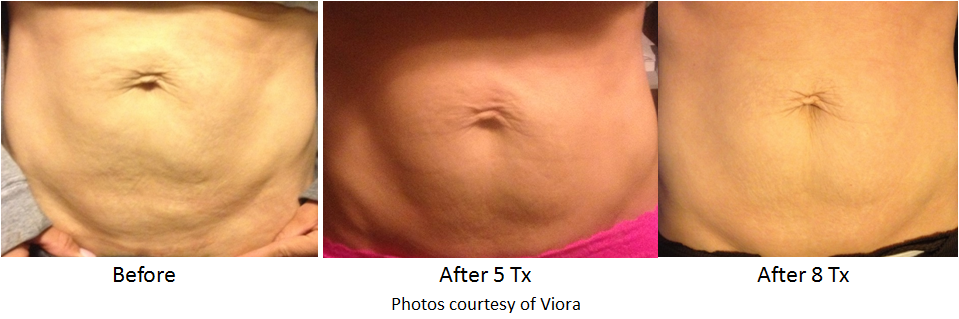 Body contouring before and after image results with refit of abdomen.