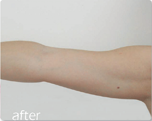 image of afer skin tightening on arm