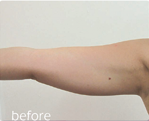 image of before skin tightening
