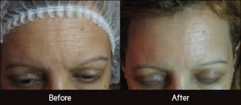 Image of microdermabrasion results before and after treatment; available at NuYou in La crosse and Onalaska, WI area