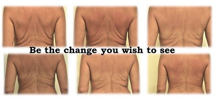 Image of back before and after Refit body contouring
