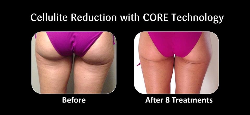 Image showing cellulite reduction following Refit body contouring treatments available at NuYou.