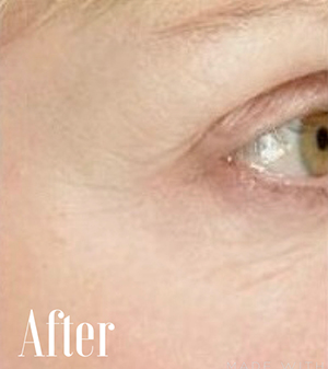 image of eye after skin tightening