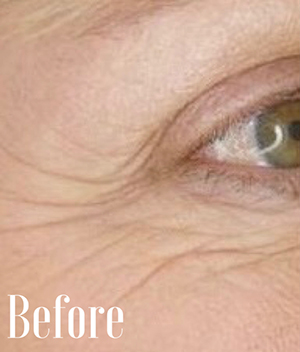 image of eye before skin tightening
