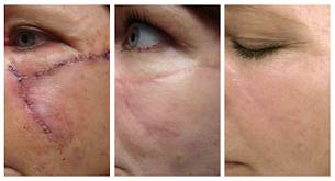 before and after image of microneedling for scarring