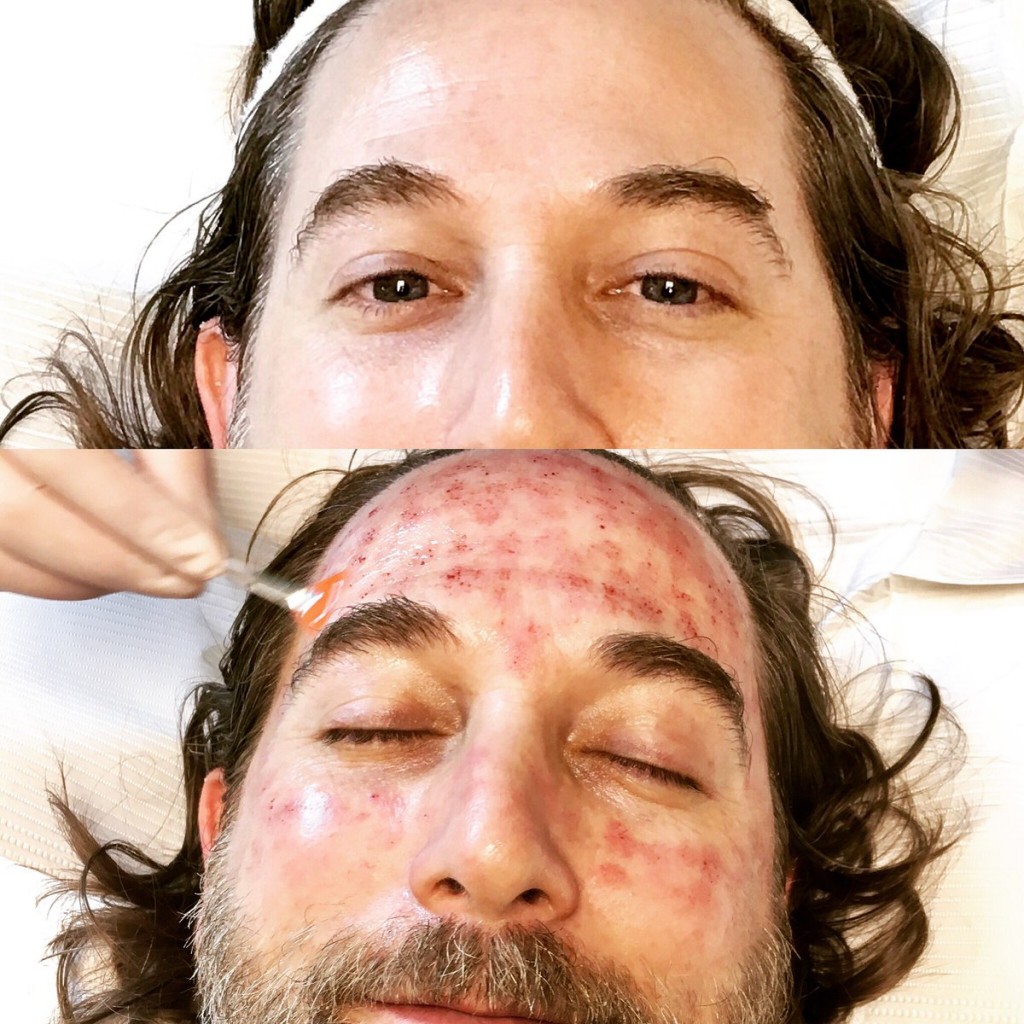 image of man's forehead for treatment and before and after microneedling treatments.
