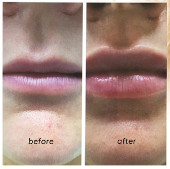 image of before and after lip plumping Relift Skin Tightening.