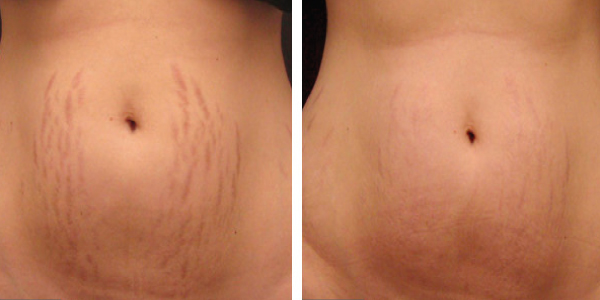 image of before and after micro-needling treatments for stretch marks