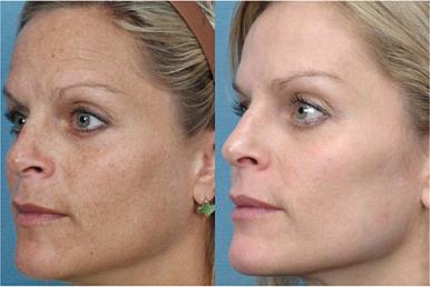 Before and After images of skin rejuvenation for age and sun spots