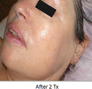 Image of skin rosacea after skin rejuvenation from NuYou.