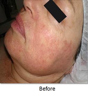 Image of skin rosacea before skin rejuvenation