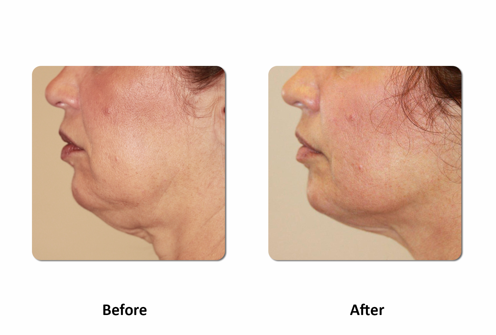 ReLift Chin 1 Before and After