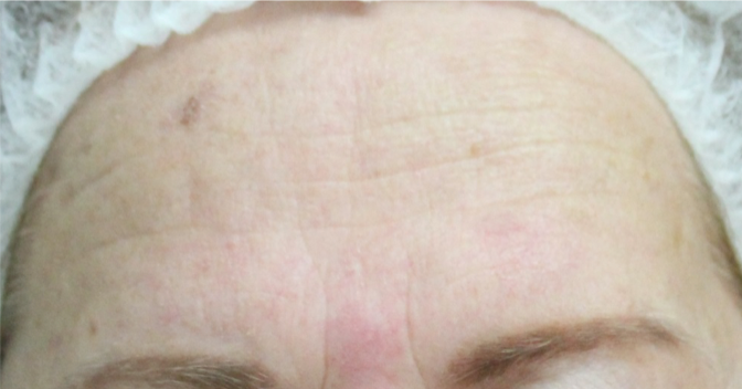image of skin rejuvenation after yag treatment