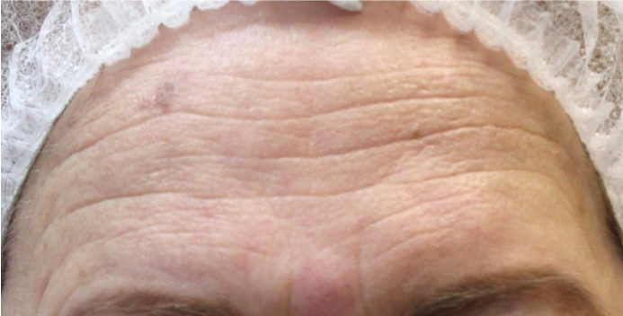 image of skin rejuvenation before yag treatment