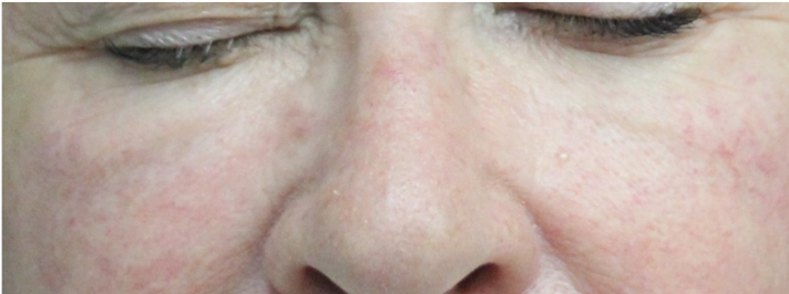 image of skin rejuvenation of eyes after yag treatment